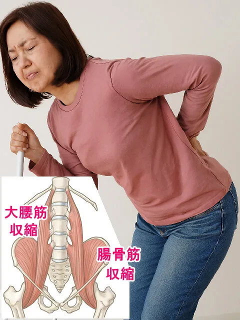 大腰筋、腸骨筋のバランスの崩れと筋肉の収縮