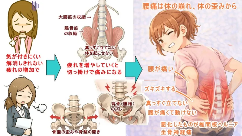 大腰筋、腸骨筋の収縮が痛みになる