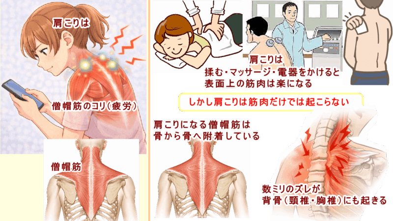 （北九州・小倉の徳力整体院は36年の実績。）肩こりは筋肉と背骨（頸椎・胸椎）のズレから