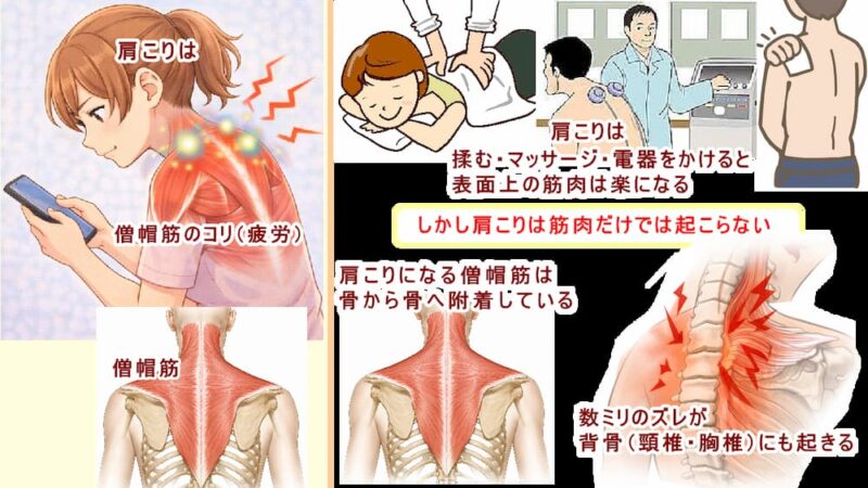 (北九州・小倉の徳力整体院は36年の実績。)肩こりは筋肉と背骨(頸椎・胸椎)のズレから